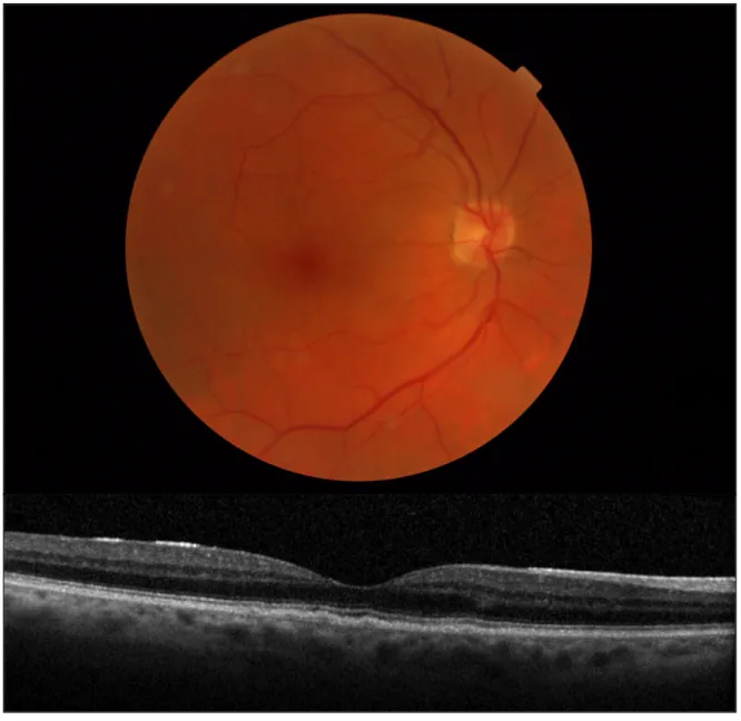 Figure 4 : Membrane épiretinenne stade 1 d’un participant de l’étude ALIENOR avec  rétinophotographie correspondante  