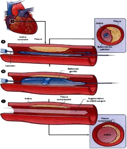 Figure 3: L'angioplastie 