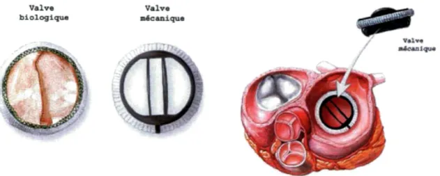 Figure 6 : Valve biologique et valve mécanique 
