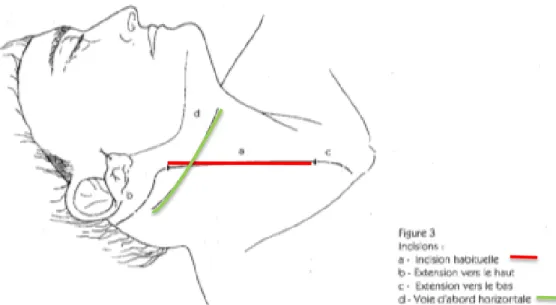 Figure 16 : Voies d’abord en chirurgie carotidienne 