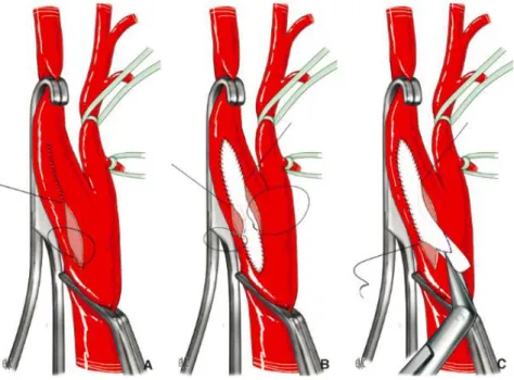 Figure 18 : Fermeture de l’artériotomie par A. suture simple B et C. patch. 