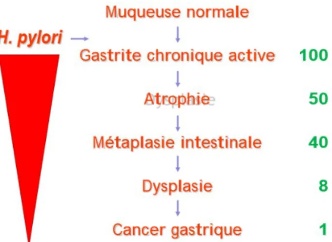 Illustration 9: Cascade des anomalies histologiques pouvant  conduire au cancer gastrique en cas d'infection à H