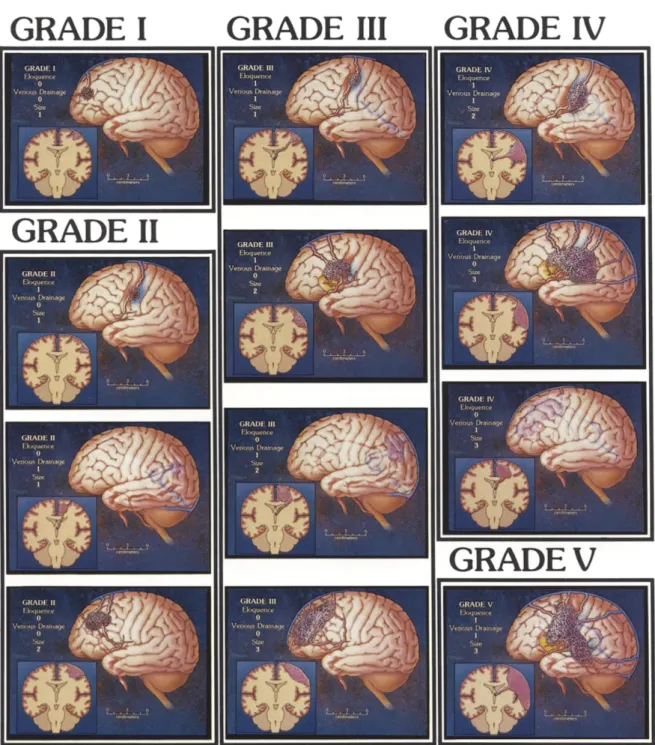 Figure 1 : Classification chirurgicale de Spetzler-Martin (SM) 