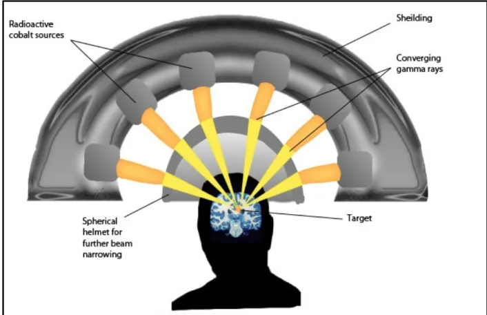 Figure 3: Principe du Gamma-Knife (89) 