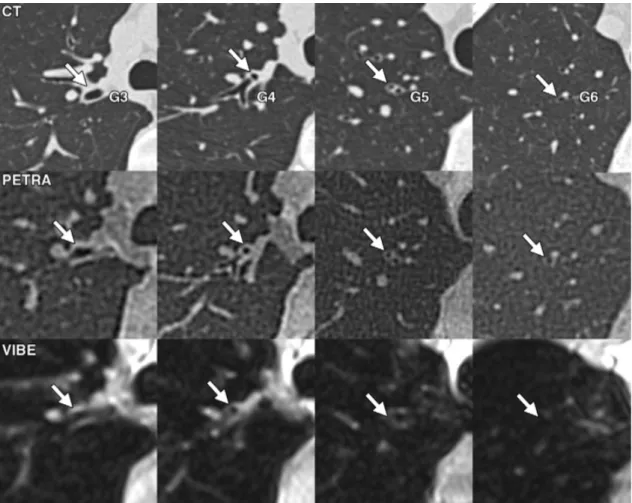 Figure 7. Coupes axiales en scanner et en IRM (séquence PETRA et VIBE) chez un volontaire sain de 33 ans
