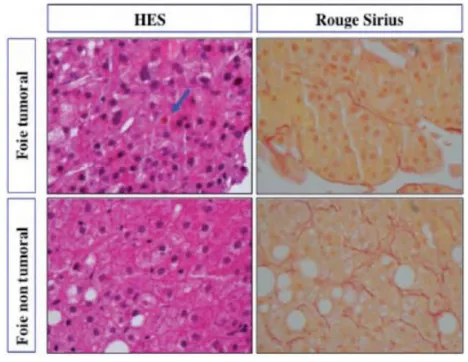 Figure 5 : Comparaison entre foie tumoral et non tumoral en coloration HES et Rouge Sirius  (Post’U, 2012, Ziol) 