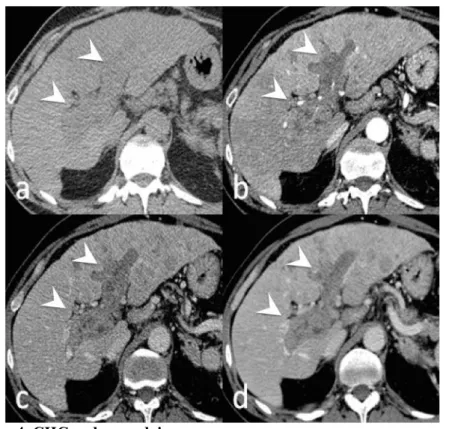 Figure 4. CHC endovasculaire au scanner 