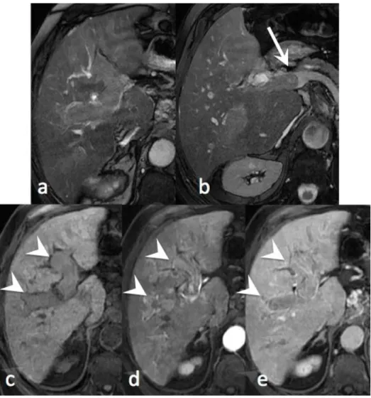 Figure 5. CHC endovasculaire en IRM 