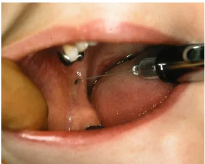 Figure 8 : Anesthésie locorégionale mandibulaire 