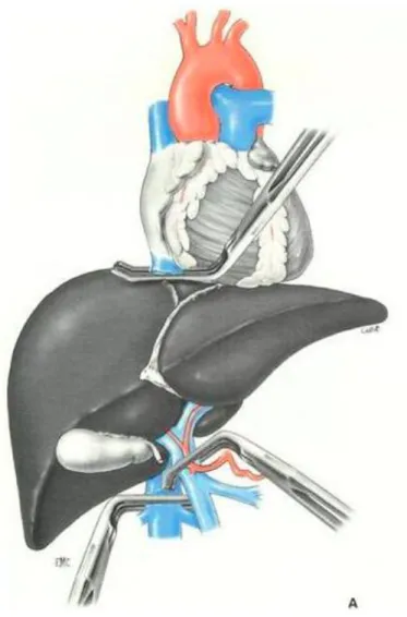 Figure 3 : exclusion vasculaire totale du foie par clampage de la veine cave inférieure sous hépatique, la  veine cave inférieure sus hépatique et le pédicule hépatique