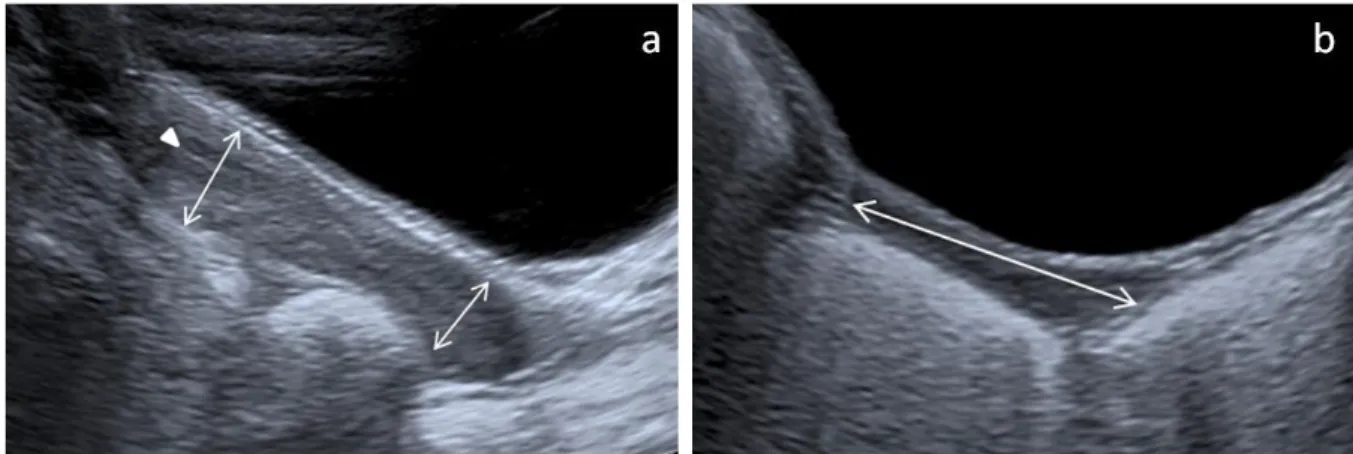 Figure 1. US appearances of the uterus. (a) pubertal uterus: the fundus is larger than the cervix (FCR>1) (narrows) and an  endometrial echo is clearly visible (narrow head)