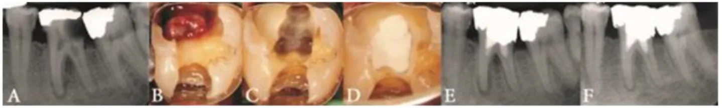 Figure 3 : Pulpotomie cervicale au CEM (Calcium Enriched Mixture) d’une molaire permanente  mature en pulpite irréversible présentant une lésion péri-apicale et une résorption radiculaire 