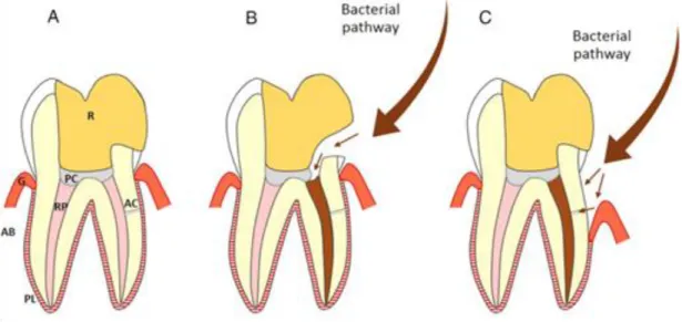 Figure 5 : Schéma représentant deux types de contamination bactérienne à la suite d’une pulpotomie  cervicale sur une dent permanente mature 