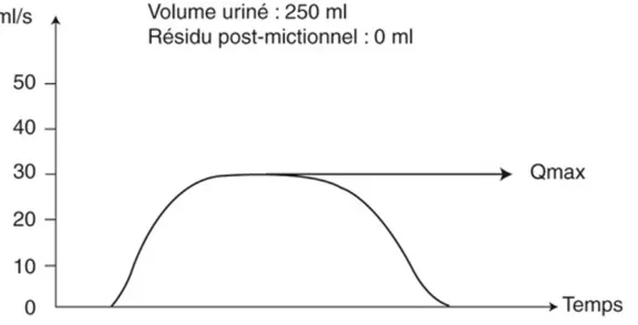 Figure 3 : Débimétrie normale 