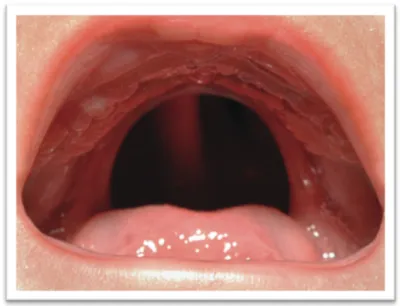 Figure 7: Fente palatine en forme de U chez un jeune patient avec une SPR. Adapté de Evans  2011