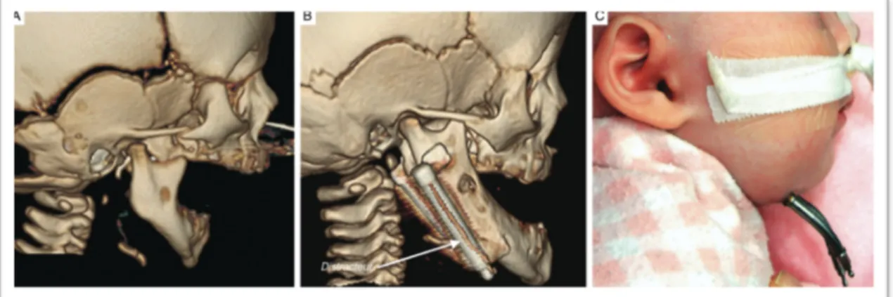 Figure 10: A: Scan en trois dimension avant la procédure de distraction, B: après la procédure  et C: photo extra-orales avec distracteurs internes