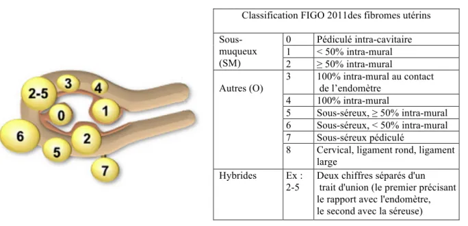 Figure   1.   Classification   des   fibromes   (5)   