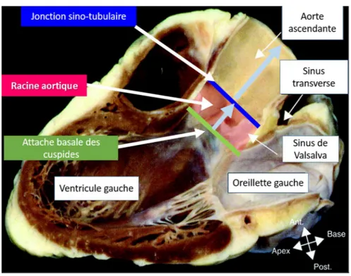 Figure 6). La racine aortique s’étend de l’attache basale des cuspides dans le ventricule gauche  jusqu’à leur attache distale à hauteur de la jonction sino-tubulaire [38]