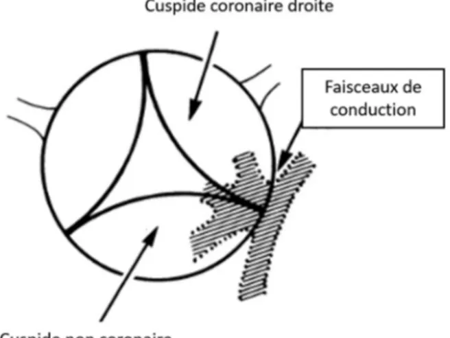 Figure 10 - Rapport intime entre le tissu de conduction ventriculaire et la valve aortique comme  vu par le chirurgien en aortotomie, d’après Anderson et al