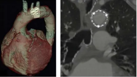 Figure 13 - Rupture aortique contenue. Contrôle TDM post-TAVI avec oversizing de la prothèse  valvulaire estimé à 15.6% comparativement à l’anneau aortique natif, d’après Blanke et al