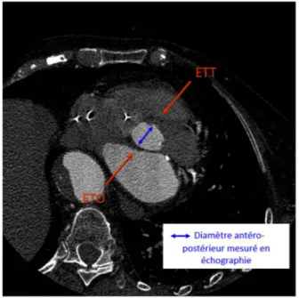 Figure 16 - Projection de la mesure échographique de l’anneau aortique en ETT et ETO sur  une reconstruction TDM dans le plan axial oblique de l’anneau aortique