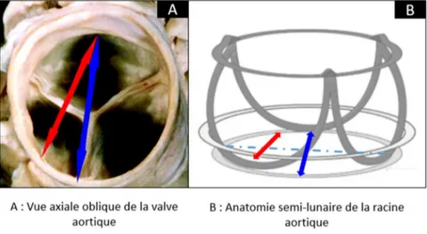 Figure 18 - Discordances entre les mesures 2D et 3D de l’anneau aortique. La mesure 2D de  l’anneau aortique reliant l’attache basale des cuspides droite et non coronaire sous-estime le  diamètre réel de l’anneau, puisque coupe tangentiellement l’anneau ao