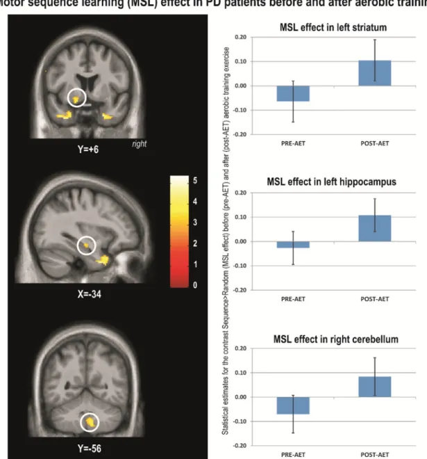 Fig. 1. Motor sequence learning (MSL) effect in PD patients before and after aerobic training.