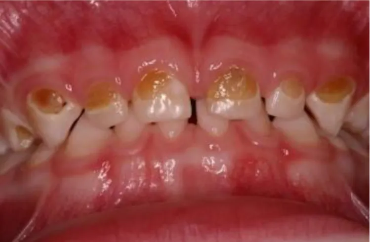 Figure 2 : Cas de caries précoces chez un jeune enfant 