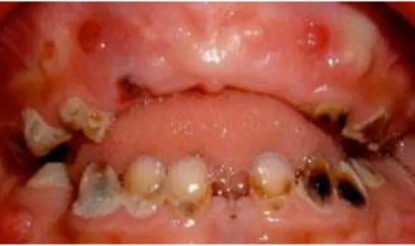 Figure 12 : Abcès et fistules en regard des dents cariées chez un enfant de 5ans 
