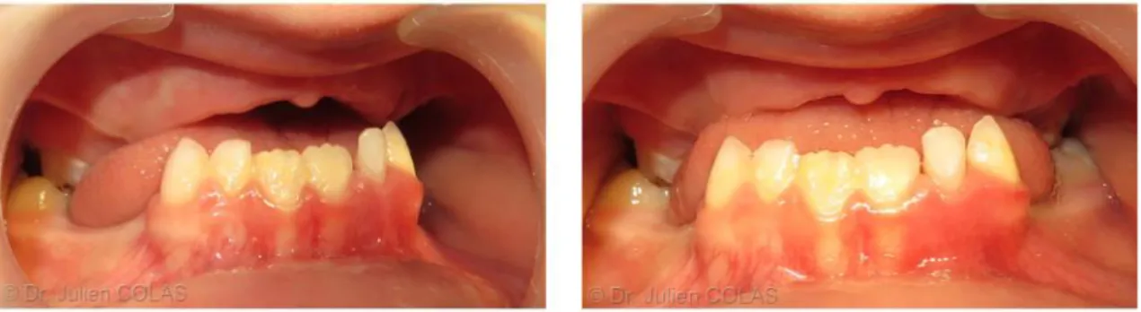 Figure 14 : Déglutition infantile chez un enfant de 6 ans 