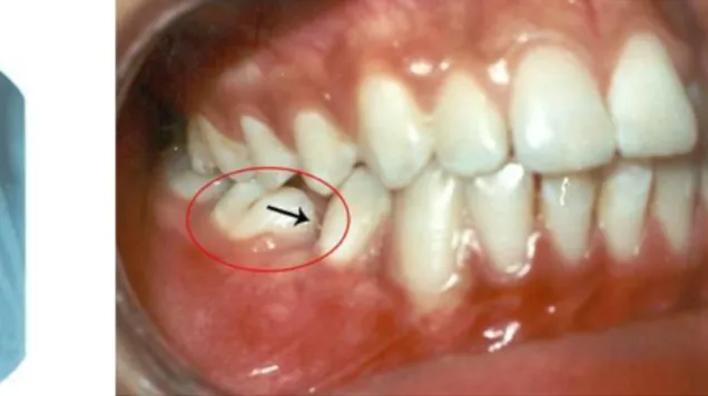 Figure 15 : Fermeture du diastème par mésialisation de la première molaire, empêchant l’éruption 