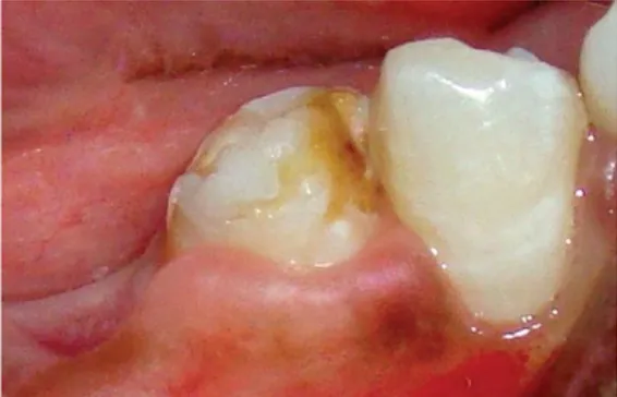 Figure 18 : Hypoplasie de 35 (dent de Turner) due à une ancienne infection d’origine carieuse sur dent  temporaire  