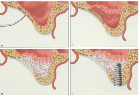Figure 3 : Schéma de l’abord latéral suivant un protocole d’érosion complète du volet, greffe osseuse  et pose immédiate d’un implant 