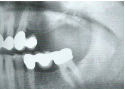 Figure 5: Défaut osseux vertical dans la zone postérieure maxillaire 