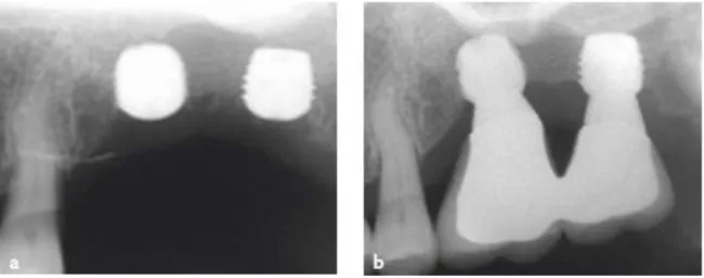 Figure 7 : Implants de 5 mm le jour de la pose (a) et après une année de mise en charge (b) dans un  secteur postérieur maxillaire fortement résorbé