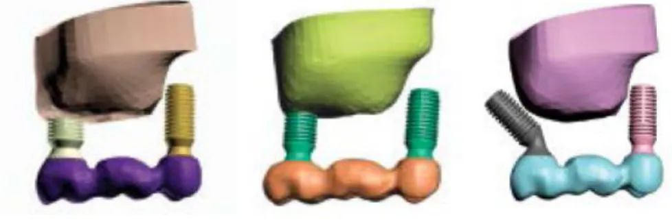 Figure 9 : Schéma illustrant la relation entre les implants et le sinus sur les modèles 1, 2 et 3 