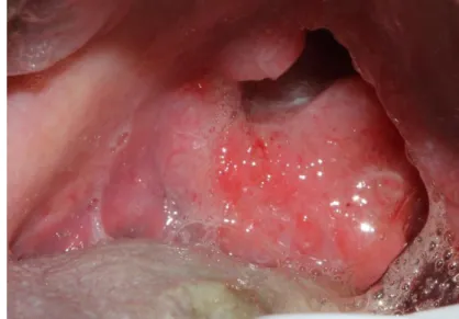 Figure 1 : Carcinome épidermoïde atteignant l’oropharynx ainsi que la base de la langue