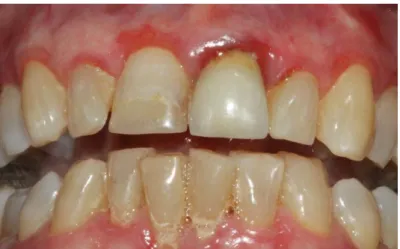 Figure 3 : Lichen plan érosif gingival. Notez la teinte rouge de la gencive libre. 