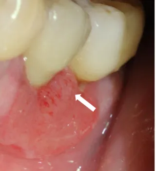 Figure 5 : Carcinome épidermoïde gingival sous sa forme ulcérée en regard de 35 et 36