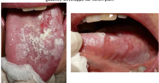 Figure 9 : Carcinome épidermoïde de la langue, forme ulcérée (a : face dorsale ; b : face latérale  gauche)