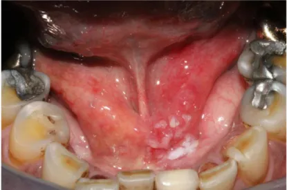 Figure 10 : Carcinome épidermoïde du plancher lingual, paramédian droit, forme ulcérée