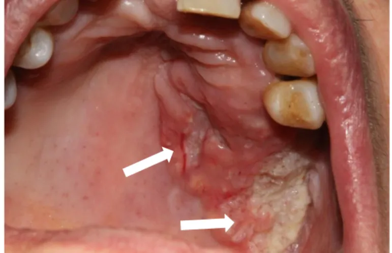 Figure 11 : Forme ulcéro-végétante d’un carcinome épidermoïde du palais, étendu à la crête  alvéolaire gauche