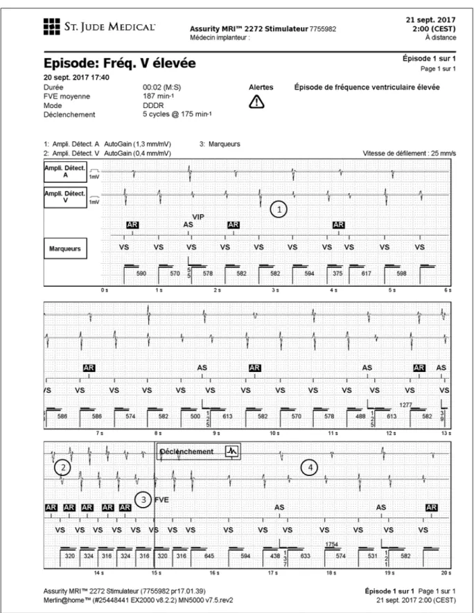 Figure 6 Transmission d’une alerte de Fréquence ventriculaire élevée (FVE) par un stimulateur Abbot Assurity DR  1 : TV lente avec dissociation AV (Fréquence V&gt;A) 