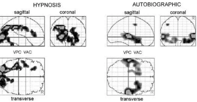 Figure 2 :  D’ap s Faymonville M-E, Boly M, Laureys S. Functional neuroanatomy of the hypnotic  state