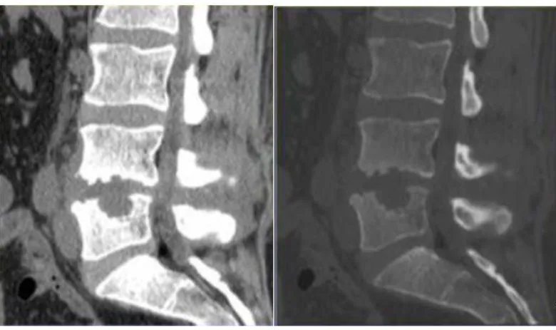 Figure 13 : TDM lombaire en coupes sagittales montrant une irrégularité et destruction des plateaux vertébraux  L4-L5 associée à un pincement discal chez une patiente de 36 ans présentant une  spondylodiscite à 6 semaines  d’une discectomie L4-L5