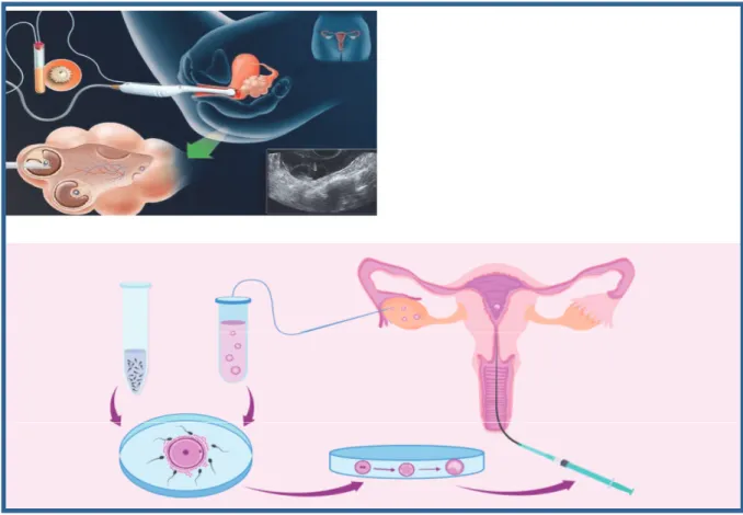Figure 10 : Différentes étapes d’une cryoconservation ovarienne / embryonnaire :  ponction d’ovocytes matures / cryoconservation ovocytaire / fécondation in vitro par 
