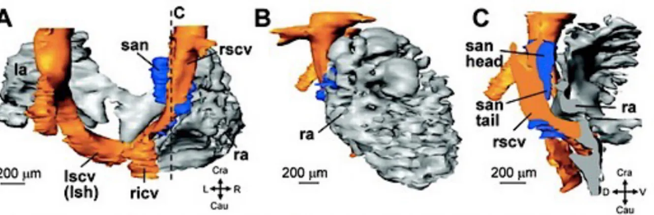 Figure 1 : (A) Reconstruction tridimensionnelle (3D) montrant la lumière des oreillettes (gris) et  de la VCS droite et gauche (orange)