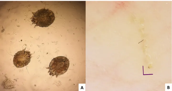 Illustration 5:  sarcoptes visualisés à l’examen direct parasitologique après prélèvement (A)