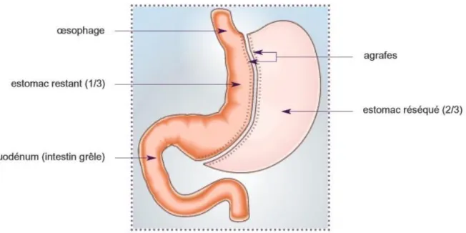 Figure 5 : La gastrectomie longitudinale ou gastrectomie en manchon ou sleeve  gastrectomy (HAS, 2009)
