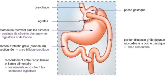 Figure 6 : Le by-pass gastrique ou court-circuit gastrique (HAS 2009). 